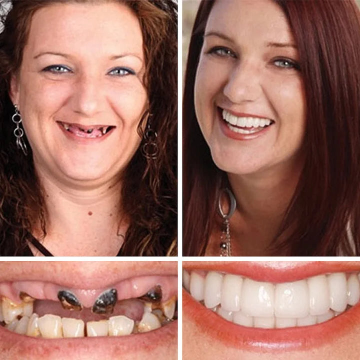 🌎Ends Today: 70% OFF! ⏰YUNPSOTM Medical Full Denture with Strong Suctiond Custom-Fit Full Functional Dentures🦷Obtain American Dental Association (ADA) Certification
