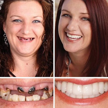 🌎Ends Today: 70% OFF! ⏰YUNPSOTM Medical Full Denture with Strong Suctiond Custom-Fit Full Functional Dentures🦷Obtain American Dental Association (ADA) Certification