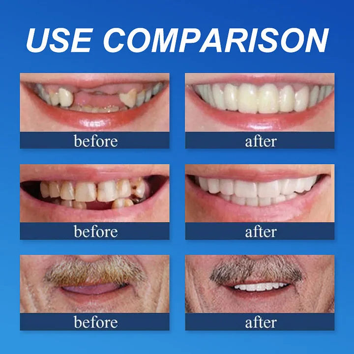 🌎Ends Today: 70% OFF! ⏰YUNPSOTM Medical Full Denture with Strong Suctiond Custom-Fit Full Functional Dentures🦷Obtain American Dental Association (ADA) Certification