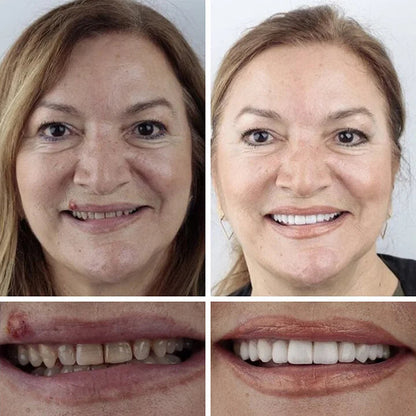🌎Ends Today: 70% OFF! ⏰YUNPSOTM Medical Full Denture with Strong Suctiond Custom-Fit Full Functional Dentures🦷Obtain American Dental Association (ADA) Certification