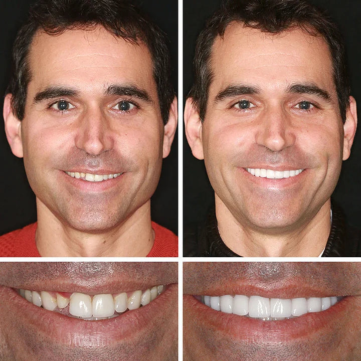 🌎Ends Today: 70% OFF! ⏰YUNPSOTM Medical Full Denture with Strong Suctiond Custom-Fit Full Functional Dentures🦷Obtain American Dental Association (ADA) Certification