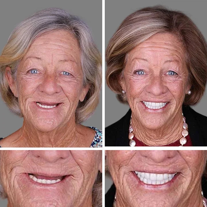 🌎Ends Today: 70% OFF! ⏰YUNPSOTM Medical Full Denture with Strong Suctiond Custom-Fit Full Functional Dentures🦷Obtain American Dental Association (ADA) Certification